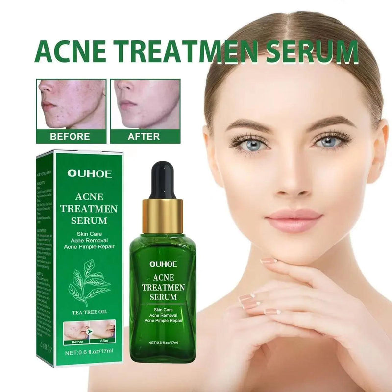 Sérum facial anti-acne