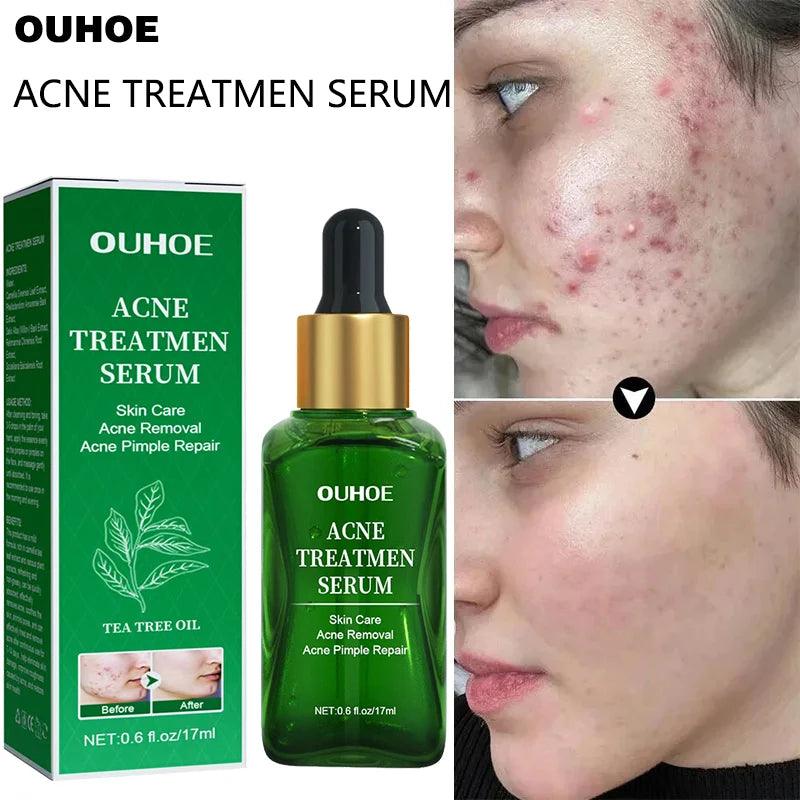 Sérum facial anti-acne