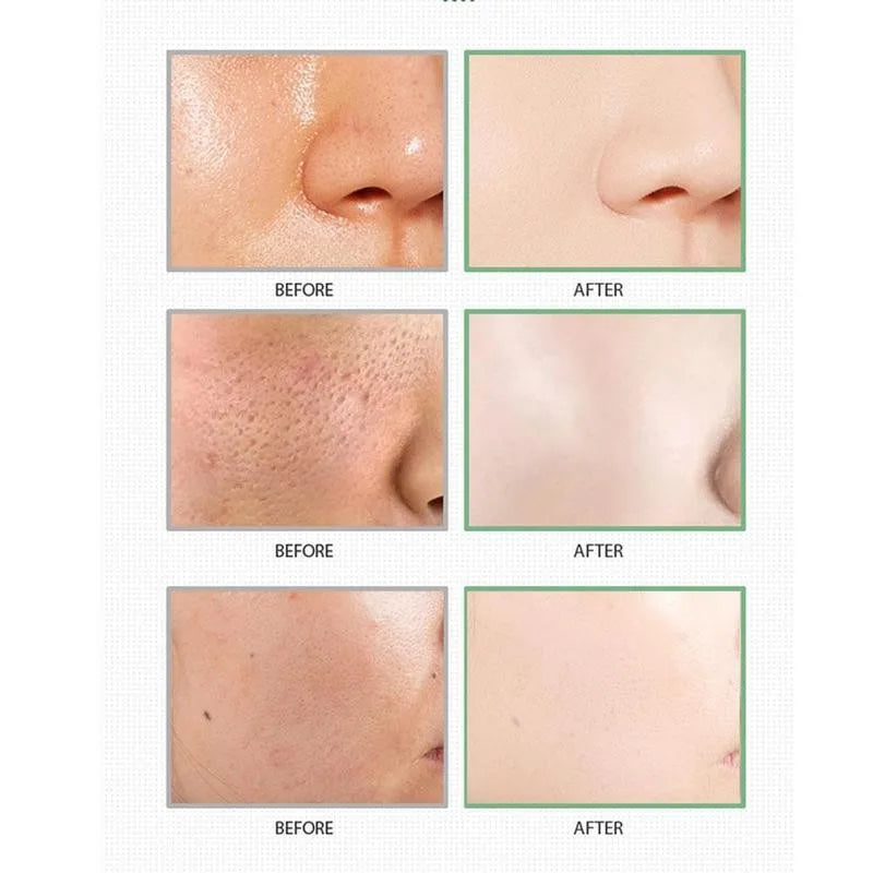 Máscara Facial Anti-Acne