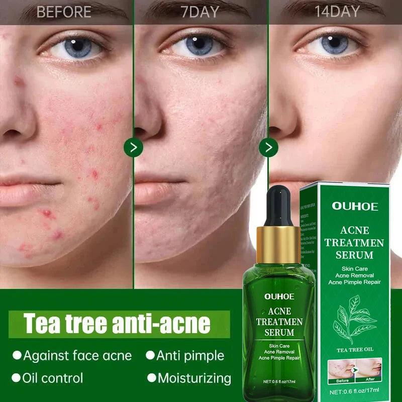 Sérum facial anti-acne